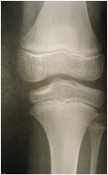 Radiographie du genou